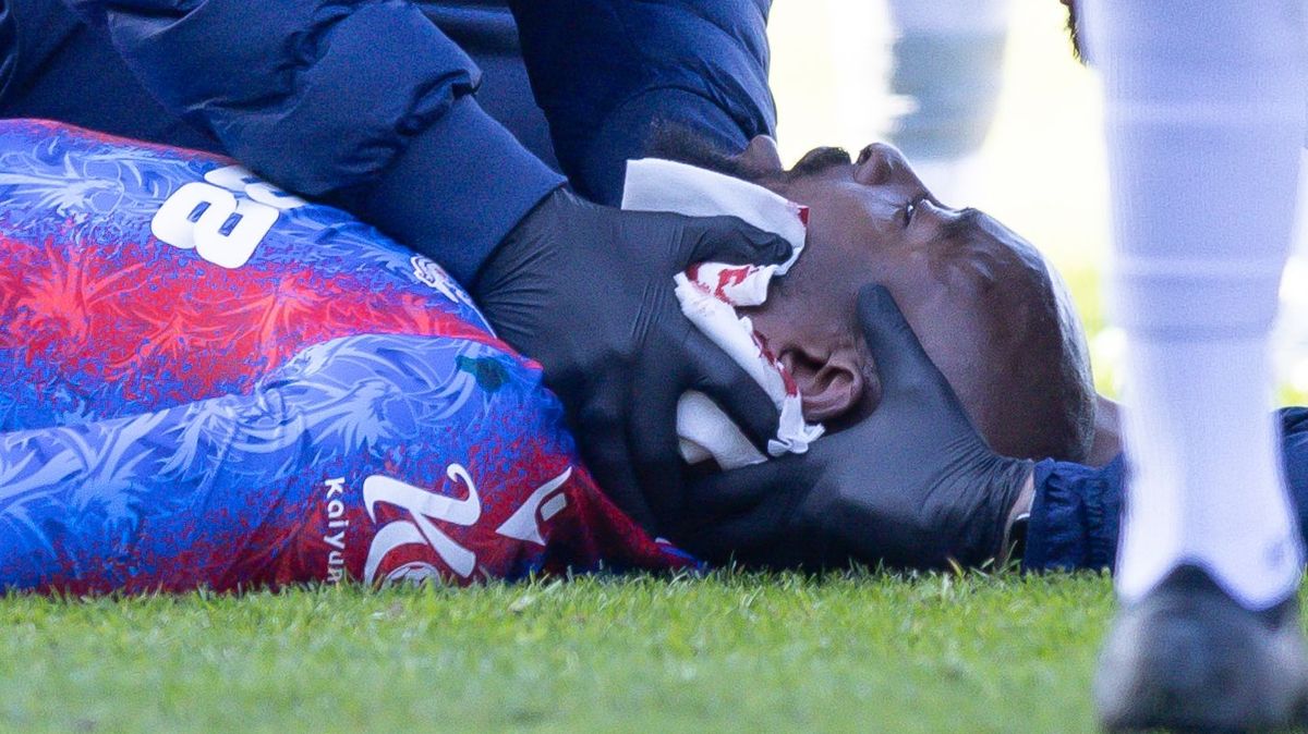 Horor v Anglii. Útočníkovi Crystal Palace sešili po šíleném faulu ucho 25 stehy